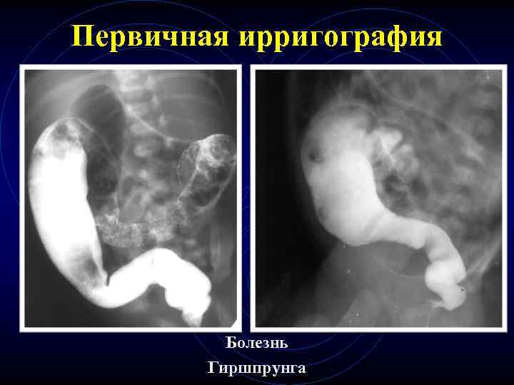 Первичная ирригография Болезнь Гиршпрунга Первичная ирригография Болезнь Гиршпрунга