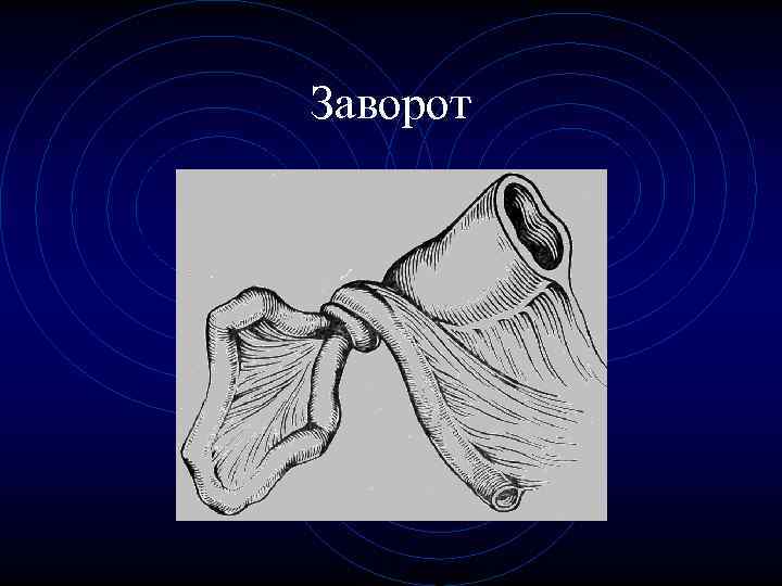 Заворот Заворот