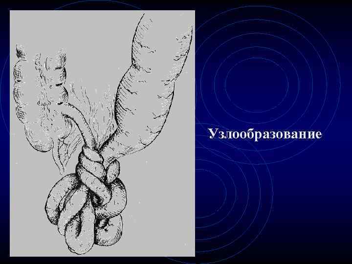 Узлообразование Узлообразование