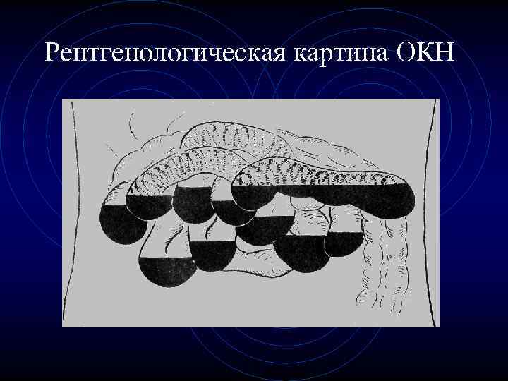 Рентгенологическая картина ОКН Рентгенологическая картина ОКН