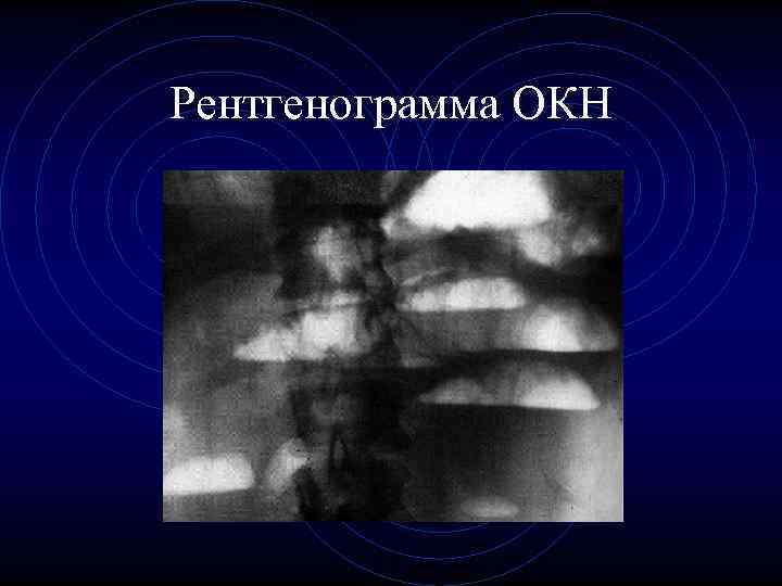 Рентгенограмма ОКН Рентгенограмма ОКН
