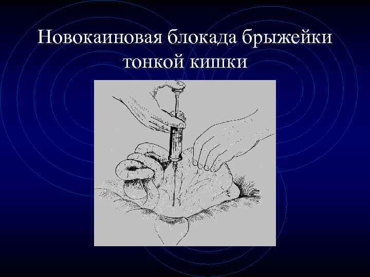 Новокаиновая блокада брыжейки тонкой кишки Новокаиновая блокада брыжейки тонкой кишки