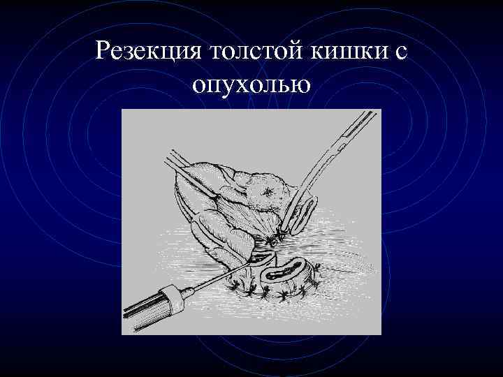 Резекция толстой кишки с опухолью Резекция толстой кишки с опухолью