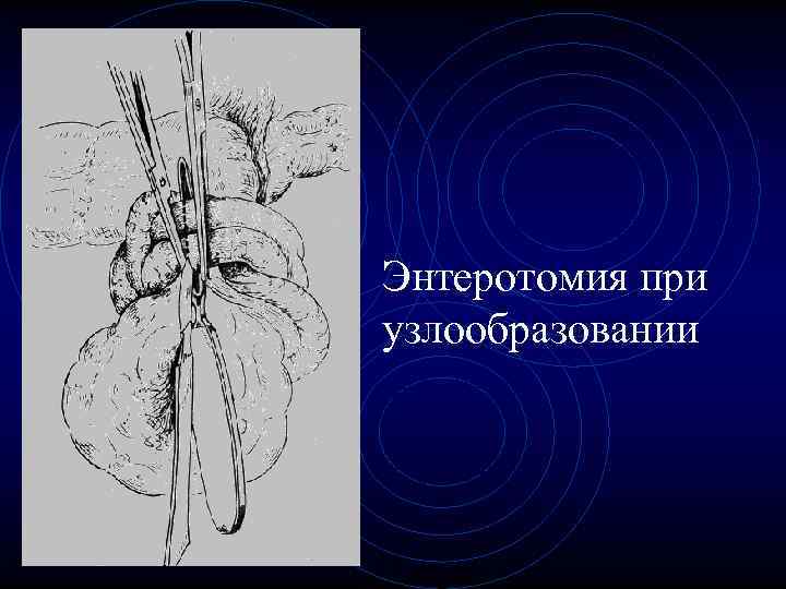Энтеротомия при узлообразовании Энтеротомия при узлообразовании