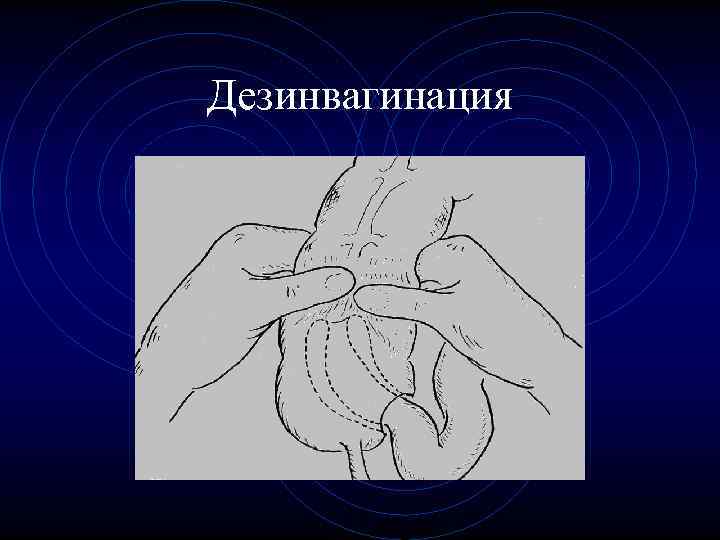 Дезинвагинация Дезинвагинация