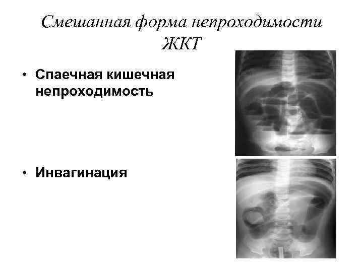  Смешанная форма непроходимости    ЖКТ • Спаечная кишечная  непроходимость •