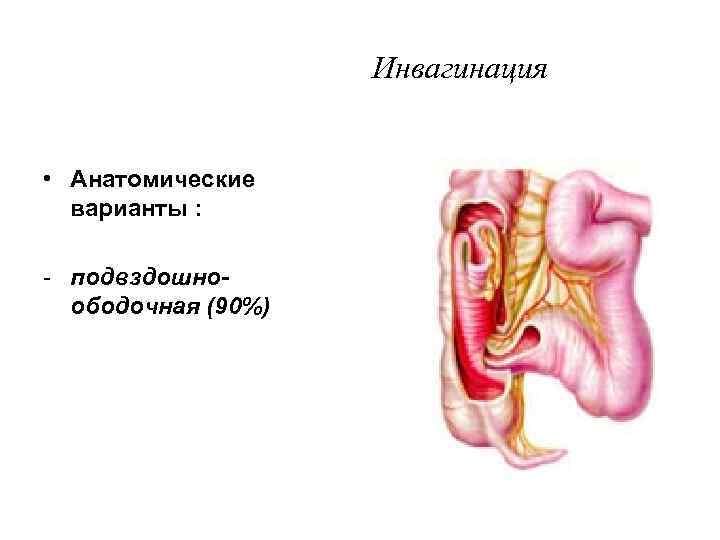     Инвагинация  • Анатомические  варианты :  - подвздошно-