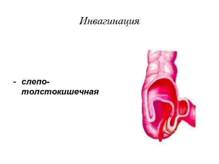   Инвагинация - слепо-  толстокишечная 