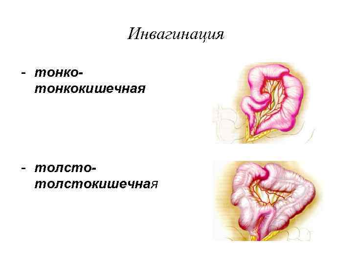   Инвагинация - тонко-  тонкокишечная - толсто-  толстокишечная 