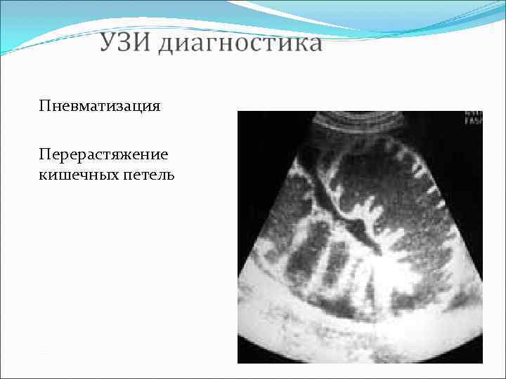 Пневматизация кишечника на узи