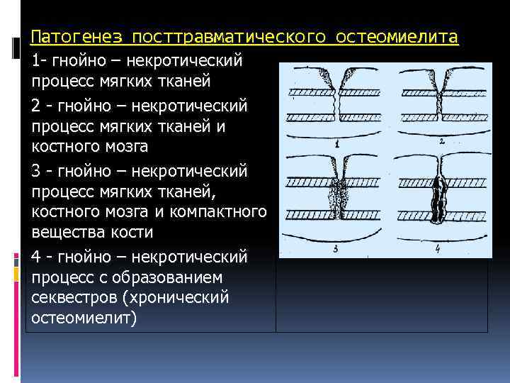Патогенез посттравматического остеомиелита 1 - гнойно – некротический процесс мягких тканей 2 - гнойно Патогенез посттравматического остеомиелита 1 - гнойно – некротический процесс мягких тканей 2 - гнойно