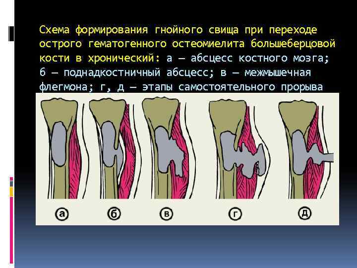 Схема формирования гнойного свища при переходе острого гематогенного остеомиелита большеберцовой кости в хронический: а Схема формирования гнойного свища при переходе острого гематогенного остеомиелита большеберцовой кости в хронический: а