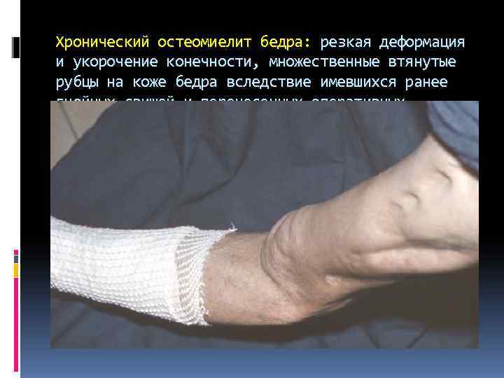Хронический остеомиелит бедра: резкая деформация и укорочение конечности, множественные втянутые рубцы на коже бедра Хронический остеомиелит бедра: резкая деформация и укорочение конечности, множественные втянутые рубцы на коже бедра