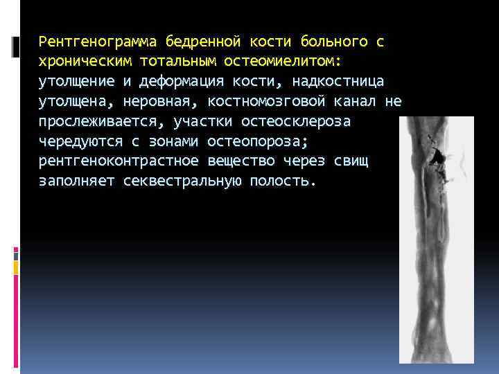 Рентгенограмма бедренной кости больного с хроническим тотальным остеомиелитом: утолщение и деформация кости, надкостница утолщена, Рентгенограмма бедренной кости больного с хроническим тотальным остеомиелитом: утолщение и деформация кости, надкостница утолщена,