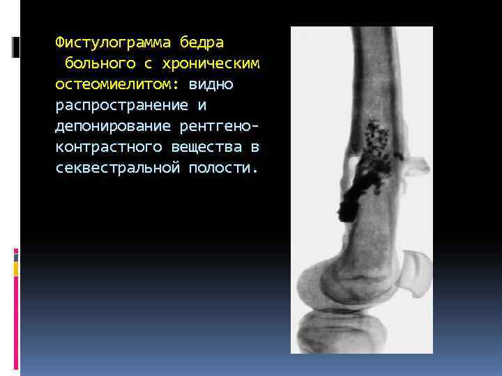 Фистулограмма бедра больного с хроническим остеомиелитом: видно распространение и депонирование рентгено- контрастного вещества в Фистулограмма бедра больного с хроническим остеомиелитом: видно распространение и депонирование рентгено- контрастного вещества в