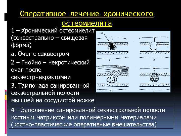 Оперативное лечение хронического остеомиелита 1 – Хронический остеомиелит (секвестрально – свищевая Оперативное лечение хронического остеомиелита 1 – Хронический остеомиелит (секвестрально – свищевая