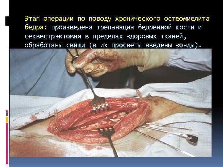 Этап операции по поводу хронического остеомиелита бедра: произведена трепанация бедренной кости и секвестрэктомия в Этап операции по поводу хронического остеомиелита бедра: произведена трепанация бедренной кости и секвестрэктомия в