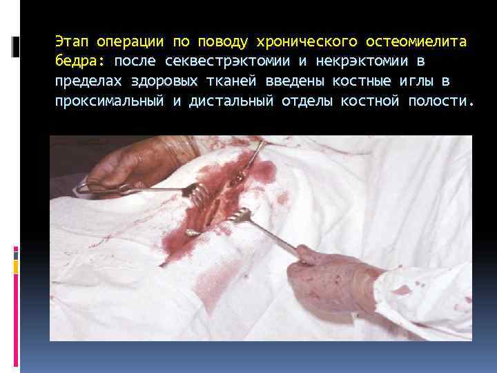 Этап операции по поводу хронического остеомиелита бедра: после секвестрэктомии и некрэктомии в пределах здоровых Этап операции по поводу хронического остеомиелита бедра: после секвестрэктомии и некрэктомии в пределах здоровых