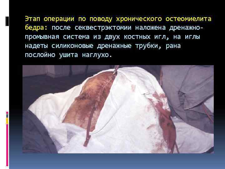 Этап операции по поводу хронического остеомиелита бедра: после секвестрэктомии наложена дренажно- промывная система из Этап операции по поводу хронического остеомиелита бедра: после секвестрэктомии наложена дренажно- промывная система из