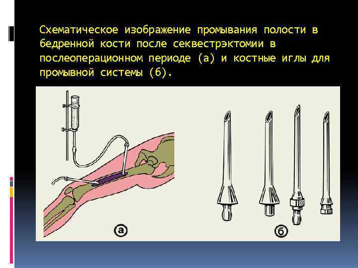 Схематическое изображение промывания полости в бедренной кости после секвестрэктомии в послеоперационном периоде (а) и Схематическое изображение промывания полости в бедренной кости после секвестрэктомии в послеоперационном периоде (а) и