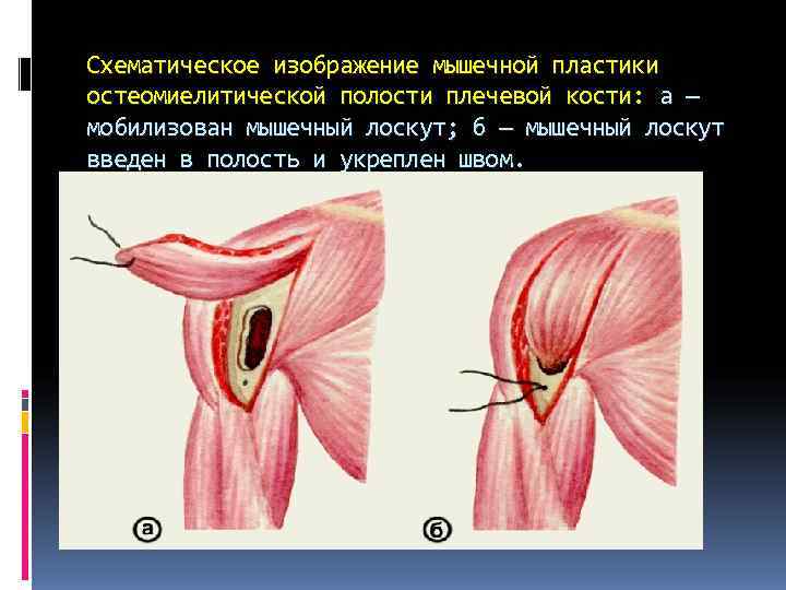 Схематическое изображение мышечной пластики остеомиелитической полости плечевой кости: а — мобилизован мышечный лоскут; б Схематическое изображение мышечной пластики остеомиелитической полости плечевой кости: а — мобилизован мышечный лоскут; б