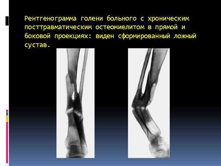 Рентгенограмма голени больного с хроническим посттравматическим остеомиелитом в прямой и боковой проекциях: виден сформированный Рентгенограмма голени больного с хроническим посттравматическим остеомиелитом в прямой и боковой проекциях: виден сформированный