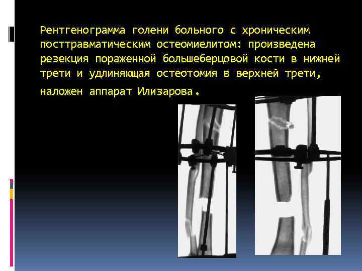 Рентгенограмма голени больного с хроническим посттравматическим остеомиелитом: произведена резекция пораженной большеберцовой кости в нижней Рентгенограмма голени больного с хроническим посттравматическим остеомиелитом: произведена резекция пораженной большеберцовой кости в нижней