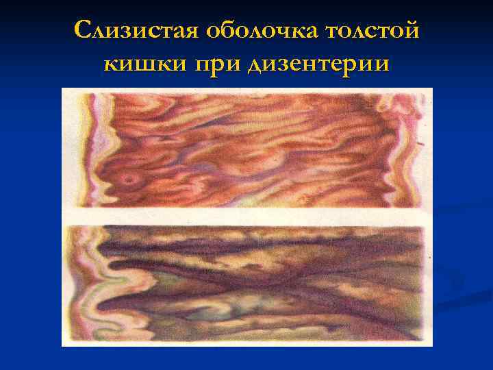Слизистая оболочка толстой  кишки при дизентерии 