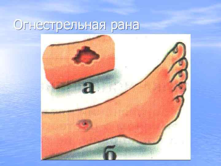 Огнестрельная рана 