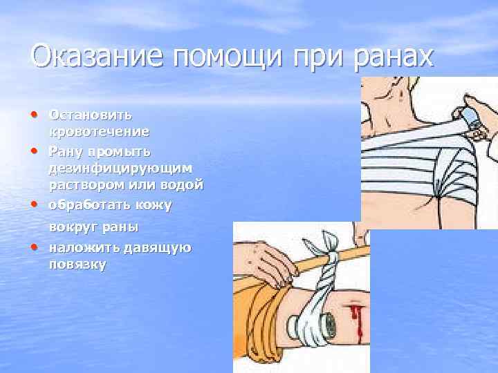 Оказание помощи при ранах • Остановить кровотечение •  Рану промыть дезинфицирующим раствором или