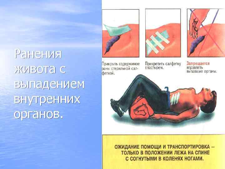 Ранения живота с выпадением внутренних органов. 