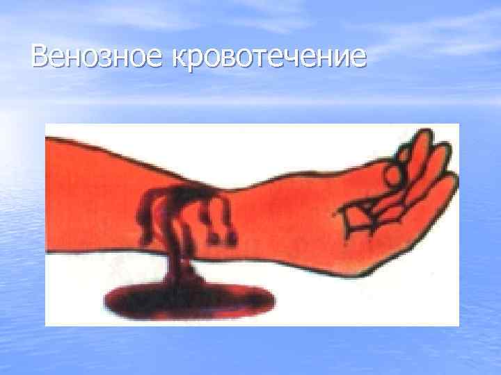 Венозное кровотечение 