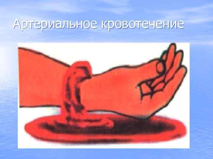Артериальное кровотечение 