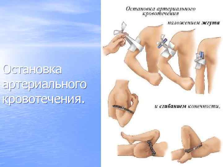 Остановка артериального кровотечения. 