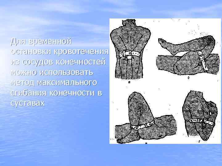 Для временной остановки кровотечения из сосудов конечностей можно использовать метод максимального сгибания конечности в
