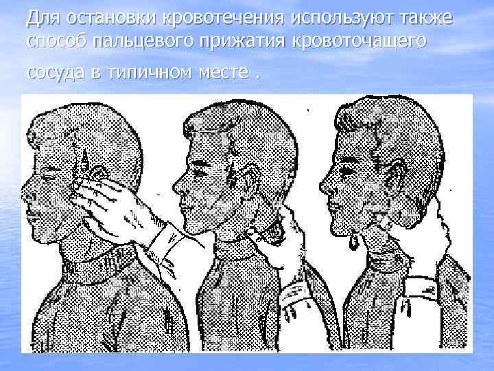 Для остановки кровотечения используют также способ пальцевого прижатия кровоточащего сосуда в типичном месте. 