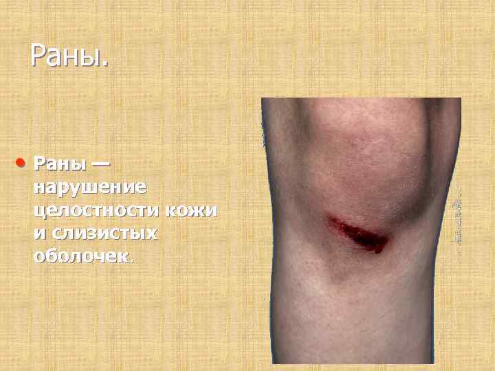  Раны. • Раны — нарушение целостности кожи и слизистых оболочек. 