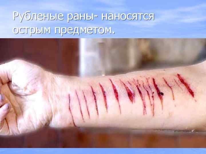 Рубленые раны- наносятся острым предметом. 