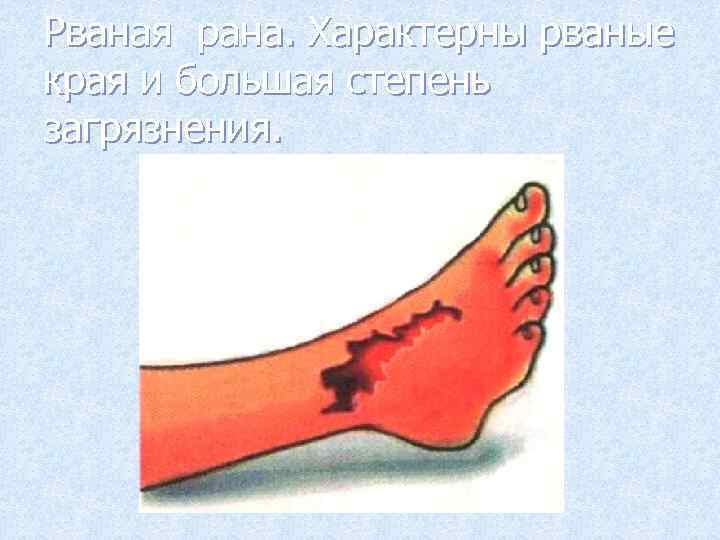 Рваная рана. Характерны рваные края и большая степень загрязнения. 