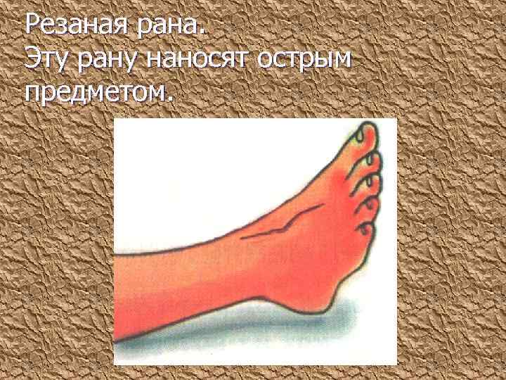 Резаная рана. Эту рану наносят острым предметом. 