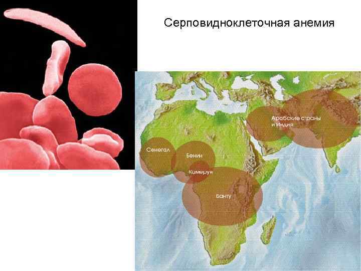 Ген серповидноклеточной анемии. Серповидноклеточная анемия и малярия. Серповидноклеточная анемия карта. Малярийный плазмодий и серповидноклеточная анемия. Карта распространения серповидноклеточной анемии.