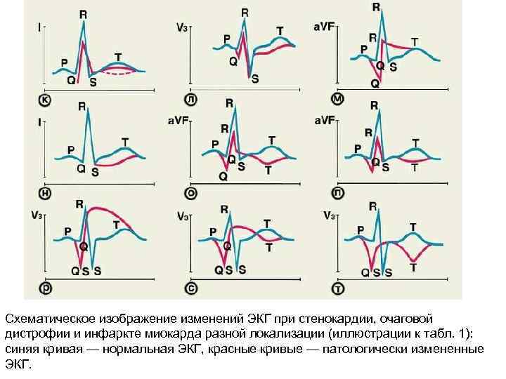 Схематическое изображение изменений ЭКГ при стенокардии, очаговой дистрофии и инфаркте миокарда разной локализации (иллюстрации