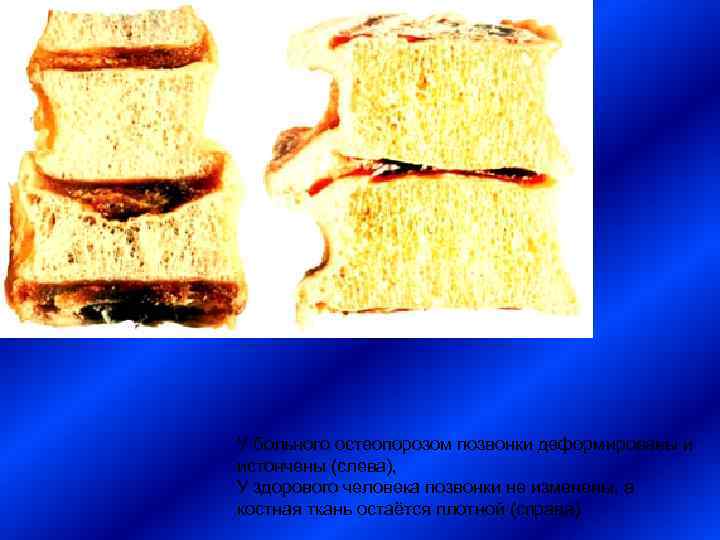 У больного остеопорозом позвонки деформированы и истончены (слева),  У здорового человека позвонки не