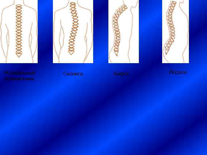 Степени кифоза позвоночника