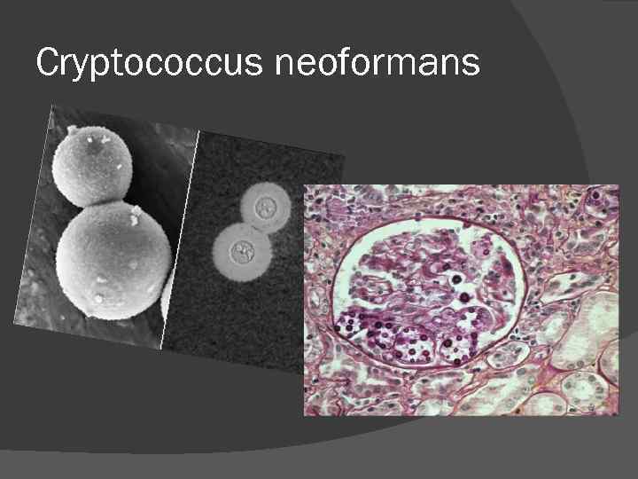 Cryptococcus neoformans Cryptococcus neoformans
