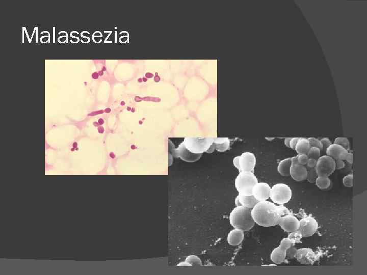 Malassezia Malassezia