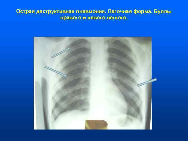 Острая деструктивная пневмония. Легочная форма. Буллы    правого и левого легкого. 