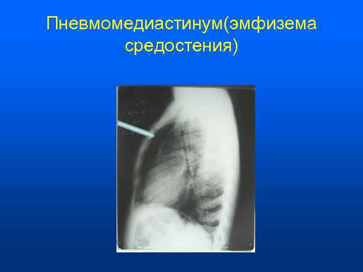 Пневмомедиастинум(эмфизема   средостения) 