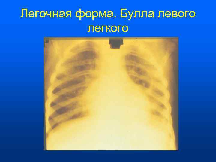 Легочная форма. Булла левого  легкого 