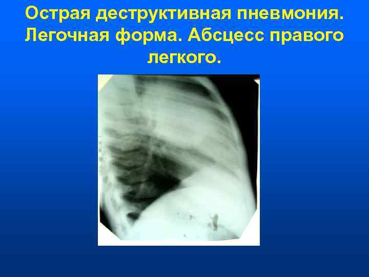 Острая деструктивная пневмония. Легочная форма. Абсцесс правого   легкого. 